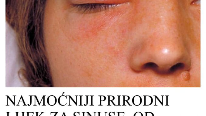 NAJMOĆNIJI PRIRODNI LIJEK ZA SINUSE, OD SAMO 2 SASTOJKA:  Prodisat ćete za tren oka