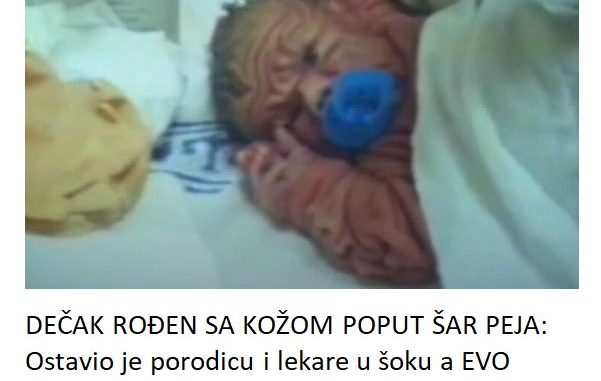 DEČAK ROĐEN SA KOŽOM POPUT ŠAR PEJA:  Ostavio je porodicu i lekare u šoku a EVO KAKO IZGLEDA 30 GODINA KASNIJE