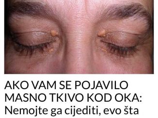 Nakupine holesterola oko očiju nastaju kao male izrasline, nalik sitnim