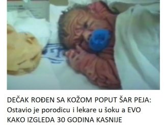 Tom Tenet rođen je sa viškom kože i doktori su bili šokirani kada su ga